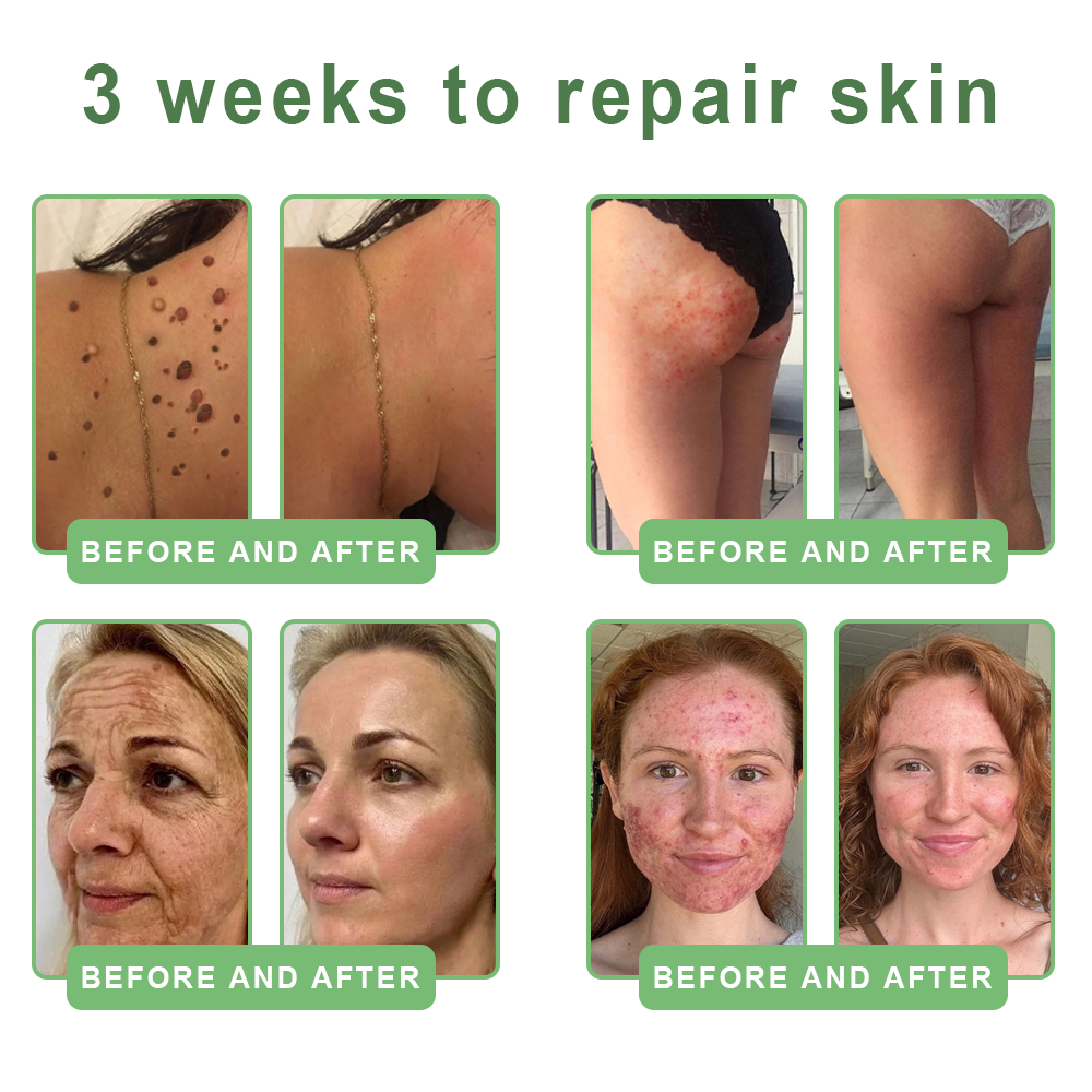 FDA Official: HISKIN® PDRN Multi-Peptide Firming Collagen Body Oil- Anti-aging, Hydrating, Skin Firming & Lifting, Skin Repair, Even Tone, Acne and Dark Spot Treatment, Wart and Mole Removal, and Psoriasis Relief.